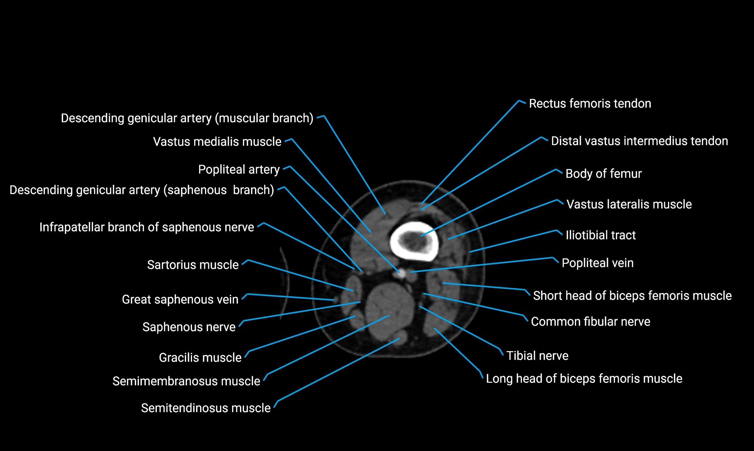 CT lower limb axial cross sectional anatomy labelled image 72 (2).webp
